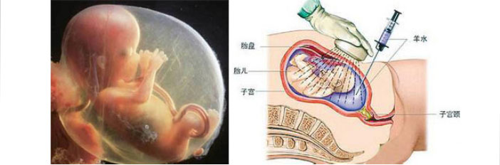 胎儿羊水采集方法